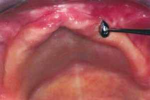 Anomalies muqueuses et fibromuqueuses