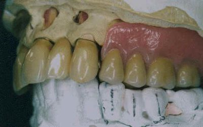 Prothèses dentaires : plombent-elles votre santé ?